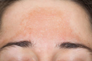 pigmentation