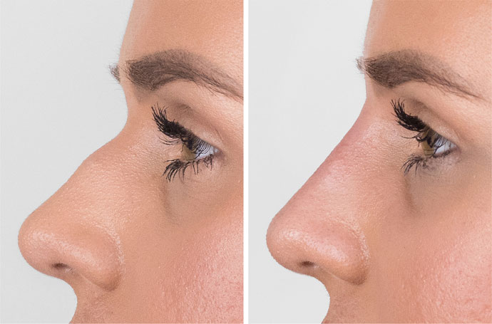 Harley street Non-Surgical Nose Job | Nose fillers - Milo Clinic