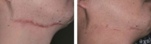Laser Genesis Scar Treatments