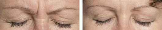 Skin Rejuvenation and Resurfacing