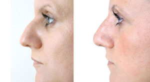 nose-shaping3