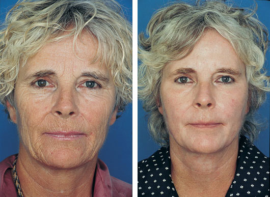 treatment factor 4 skin skin Street treatment Harley clinic Obagi Skin  peel