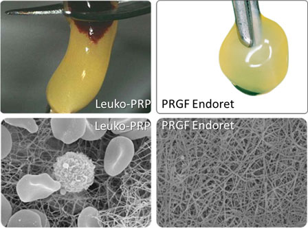 PRGF plasma