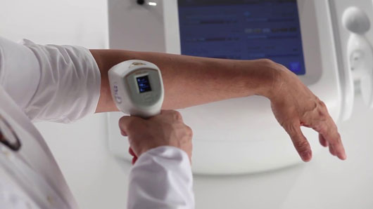 laser hair removal